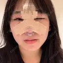 鼻尖形成（切開） / 鼻中隔延長（切開） / 軟骨移植 / その他（鼻） KAUNIS CLINIC（カウニスクリニック） DAY 2 サムネイル用