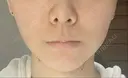 脂肪吸引（顔） Mods Clinic（モッズクリニック） 東京院 DAY 7 サムネイル用