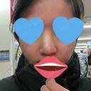 プロテーゼ除去 四谷見附クリニック DAY 0 サムネイル用