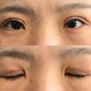二重切開 城本クリニック 福岡院 DAY 38 サムネイル用