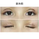 二重切開 / 上まぶたたるみ取り / 目元修正 サラ美容外科 DAY 6 サムネイル用