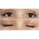 二重切開 / 上まぶたたるみ取り / 目元修正 サラ美容外科 DAY 7 サムネイル用