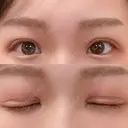 二重切開 EMMA CLINIC（エマクリニック） DAY 41 サムネイル用