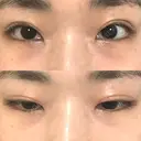 二重切開 / 上まぶたの脂肪取り 松下皮フ形成外科 DAY 46 サムネイル用