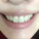 ガミースマイル手術 有楽町美容外科クリニック DAY 5 サムネイル用