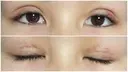 二重切開 / 上まぶたたるみ取り / 目元修正 サラ美容外科 DAY 8 サムネイル用