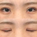 二重切開 城本クリニック 福岡院 DAY 41 サムネイル用