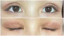 二重切開 / 上まぶたたるみ取り / 目元修正 サラ美容外科 DAY 9 サムネイル用
