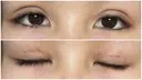 二重切開 / 上まぶたたるみ取り / 目元修正 サラ美容外科 DAY 10 サムネイル用