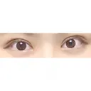 二重切開 / 目頭切開 東京イセアクリニック DAY 67 サムネイル用