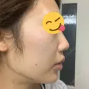 ボトックス（あご） / ヒアルロン酸注入（あご） TCB東京中央美容外科 銀座有楽町院 DAY 8 サムネイル用