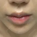 ボトックス（あご） / ヒアルロン酸注入（あご） TCB東京中央美容外科 銀座有楽町院 DAY 8 サムネイル用