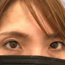 二重切開 / 眼瞼下垂（切開） / 上まぶたたるみ取り 湘南美容クリニック 高田馬場院 DAY 108 サムネイル用