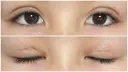 二重切開 / 上まぶたたるみ取り / 目元修正 サラ美容外科 DAY 11 サムネイル用