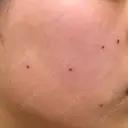 ほくろ・いぼ切除（肌） 品川スキンクリニック岡山院 DAY 2 サムネイル用