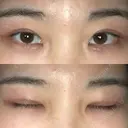二重切開 / 眼瞼下垂（切開） ブリスクリニック形成外科・美容外科・美容皮膚科 福岡 DAY 29 サムネイル用