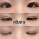 目頭切開 / 眼瞼下垂（切開） 白山クリニック 大分 DAY 21 サムネイル用