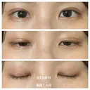 二重埋没 湘南美容クリニック 藤沢院 AFTER サムネイル用