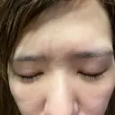 二重埋没 / 下まぶたの脂肪取り 品川美容外科 福岡院 DAY 21 サムネイル用