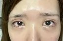 二重埋没 / 下まぶたの脂肪取り 品川美容外科 福岡院 DAY 21 サムネイル用