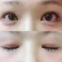 二重切開 / 眼瞼下垂（切開） / 目尻切開 ジュエリー美容外科 DAY 61 サムネイル用