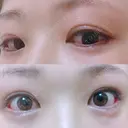 二重切開 / 眼瞼下垂（切開） / 目尻切開 ジュエリー美容外科 DAY 61 サムネイル用