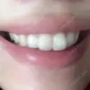 ガミースマイル手術 有楽町美容外科クリニック DAY 7 サムネイル用