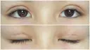 二重切開 / 上まぶたたるみ取り / 目元修正 サラ美容外科 DAY 12 サムネイル用