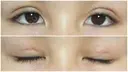 二重切開 / 上まぶたたるみ取り / 目元修正 サラ美容外科 AFTER サムネイル用