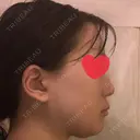 骨切り（あご） / 骨削り（エラ） リラ・クラニオフェイシャル・クリニック DAY 181 サムネイル用