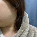 ボトックス（エラ・小顔） TCB東京中央美容外科 立川院 DAY 0 サムネイル用