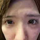 二重埋没 / 下まぶたの脂肪取り 品川美容外科 福岡院 DAY 25 サムネイル用