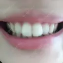ガミースマイル手術 有楽町美容外科クリニック DAY 8 サムネイル用