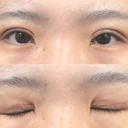 二重切開 城本クリニック 福岡院 DAY 49 サムネイル用