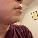 医療脱毛（顔） 自由が丘クリニック DAY 0 サムネイル用