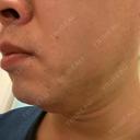 医療脱毛（顔） 自由が丘クリニック DAY 1 サムネイル用