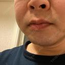 医療脱毛（顔） 自由が丘クリニック DAY 2 サムネイル用