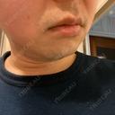 医療脱毛（顔） 自由が丘クリニック AFTER サムネイル用