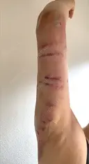 脂肪吸引（二の腕） 石倉クリニック 水戸院 DAY 1 サムネイル用
