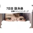 二重埋没 / 目頭切開 かめい美容クリニック宇都宮 DAY 7 サムネイル用