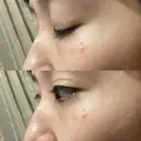 クマ治療 / 下まぶたたるみ取り セオリークリニック DAY 28 サムネイル用