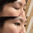 クマ治療 / 下まぶたたるみ取り セオリークリニック DAY 28 サムネイル用