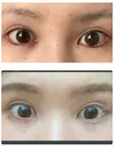 目尻切開 / タレ目形成・グラマラスライン（切開） ビスポーククリニック 福岡院 DAY 34 サムネイル用