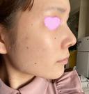 鼻中隔延長（切開） / 軟骨移植 / 眉間プロテーゼ ビスポーククリニック 福岡院 DAY 34 サムネイル用