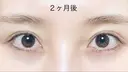 二重切開 / 上まぶたたるみ取り R.O.clinic DAY 60 サムネイル用