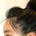 脂肪注入（肌） / 切開リフト / ボトックス（エラ・小顔） / 脂肪注入（輪郭） / ヒアルロン酸注入（額） / その他（口元） 石倉クリニック 水戸院 DAY 60 サムネイル用