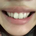 ガミースマイル手術 有楽町美容外科クリニック AFTER サムネイル用