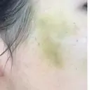 糸リフト ニューセンス皮膚科クリニック DAY 6 サムネイル用