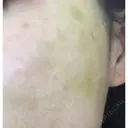 糸リフト ニューセンス皮膚科クリニック DAY 5 サムネイル用