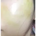 糸リフト ニューセンス皮膚科クリニック DAY 12 サムネイル用